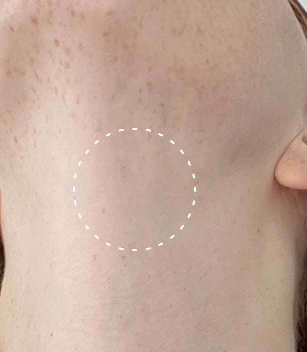 Image of a person's neck, their eczema has healed